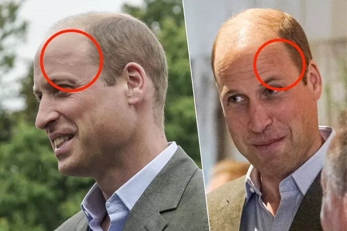 D’où vient cette étrange cicatrice sur le front du prince William?