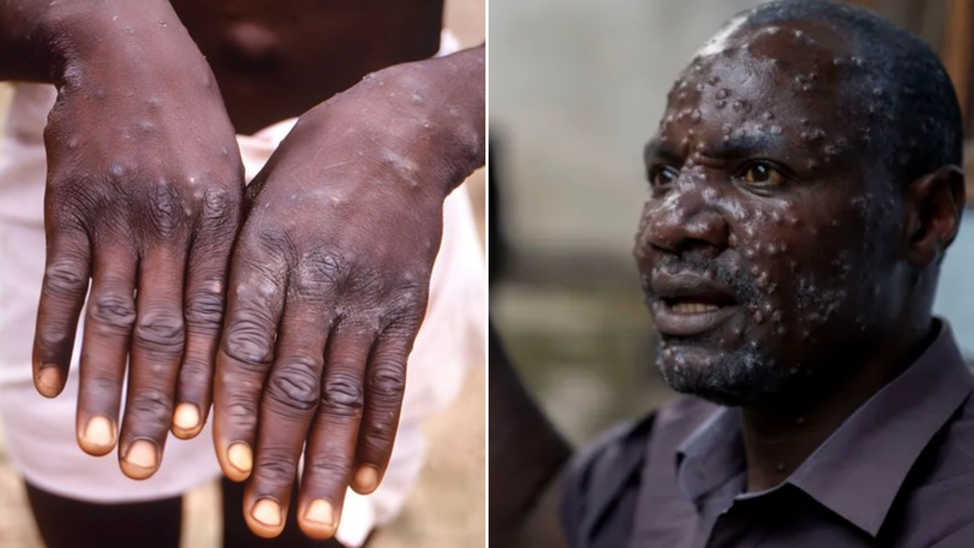 Epidémie Mpox : le Sénégal active un plan de riposte géré par le Dr Boly Diop