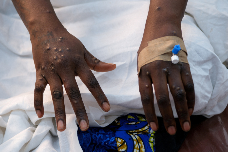 Mpox: l'OMS maintient son plus haut niveau d'alerte