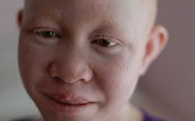 Victime de l’indifférence des populations, les Albinos crient leur ras-le-bol