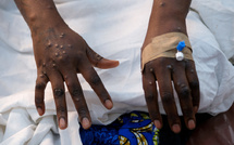 Mpox: l'OMS maintient son plus haut niveau d'alerte